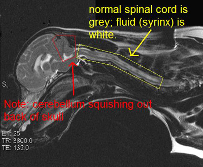 MRI-scan syringomyelia